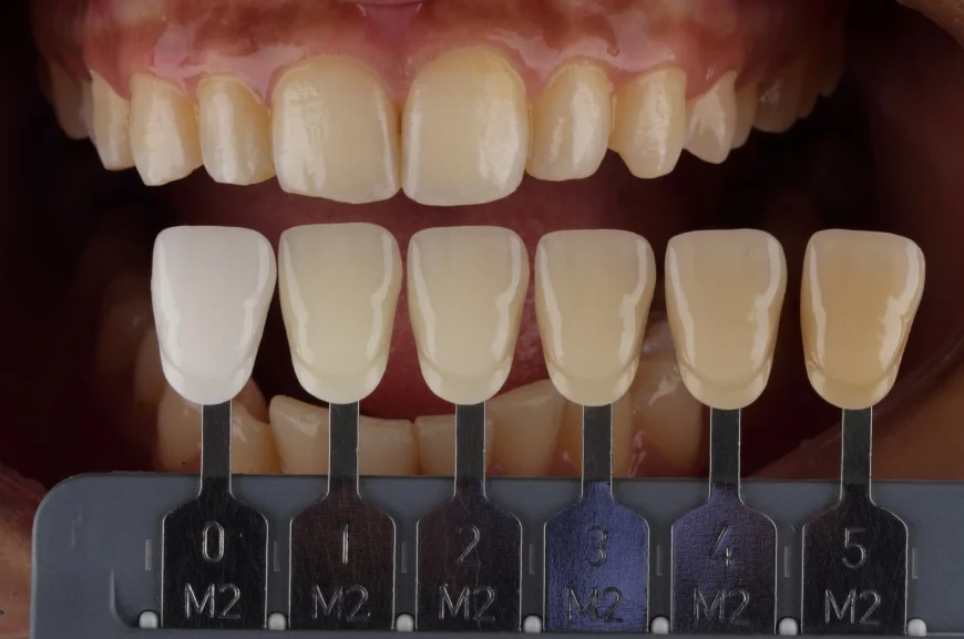 Dentist doing shade matching and final adjustments during cosmetic dental treatment in Patna
