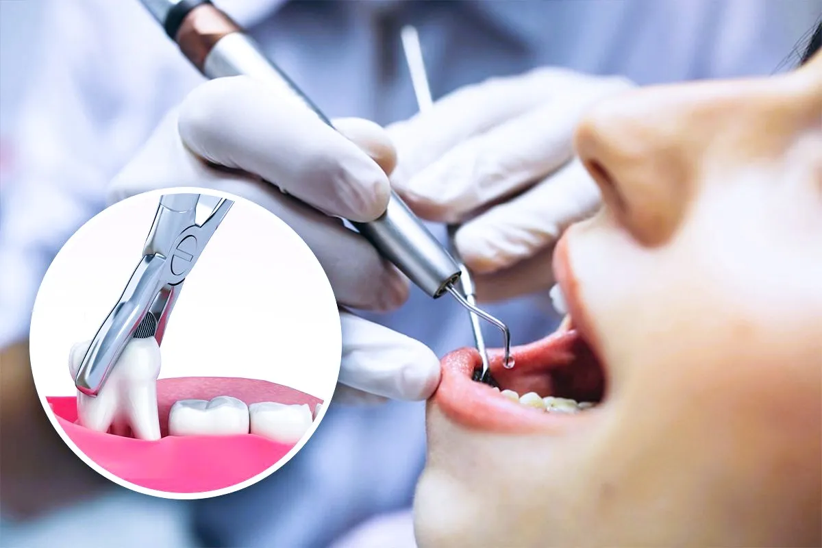 Simple tooth extraction procedure in Patna