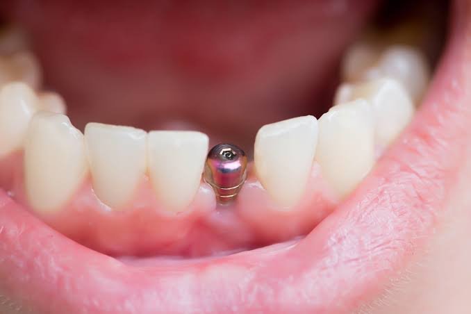 Single tooth dental implant replacing a missing tooth in Patna