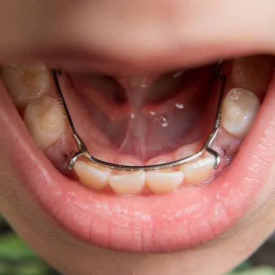 Pediatric dental space maintainer used to guide proper tooth alignment in children in Patna