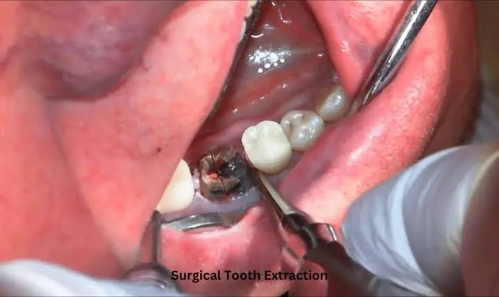 Surgical tooth extraction procedure in Patna