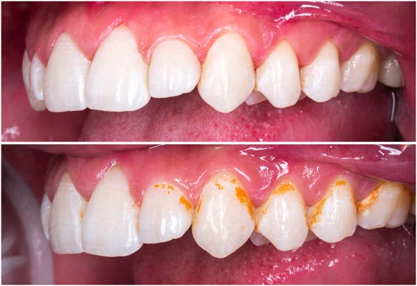 Dental stain removal treatment for teeth stained by tea, coffee, or tobacco