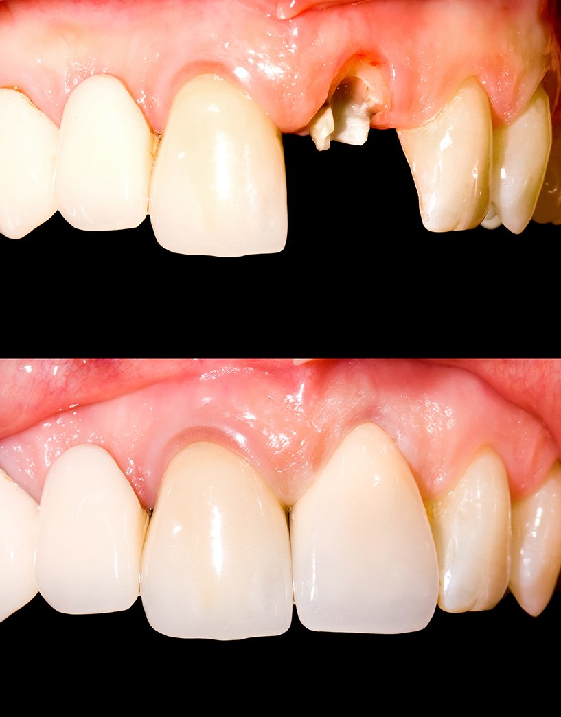 Dentist placing a temporary crown to protect prepared tooth before final crown and bridge fitting in Patna