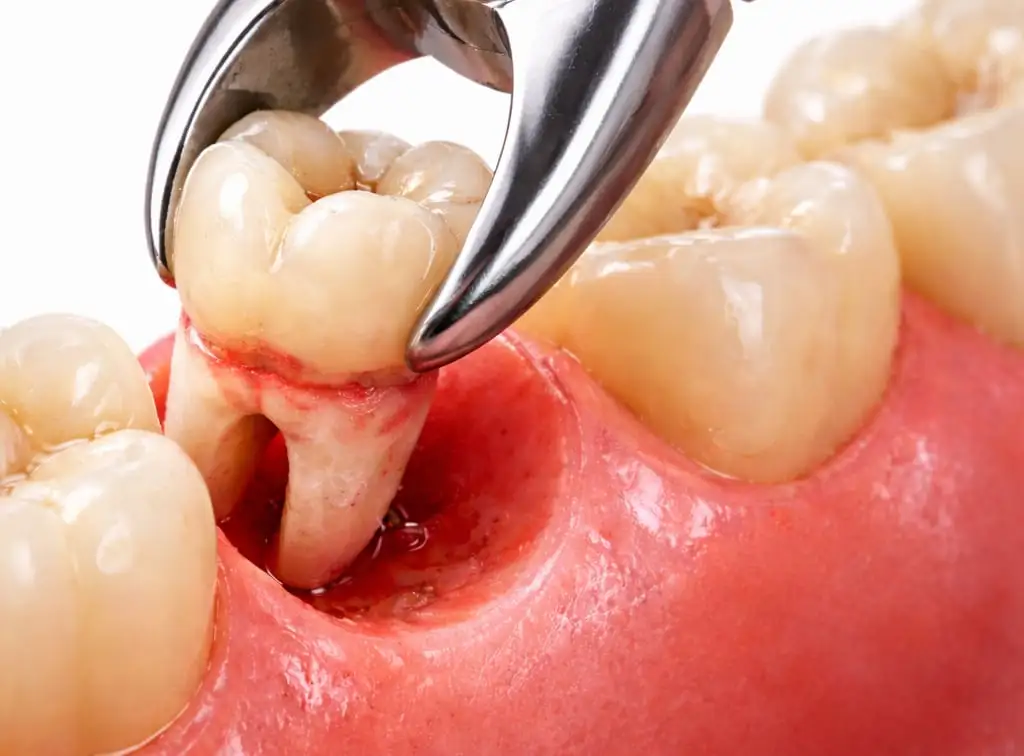 Safe tooth extraction treatment in Patna at Dental Comfort Zone