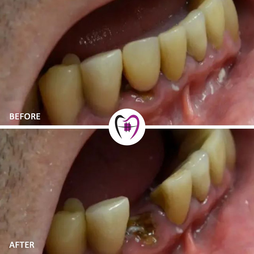 Dentist performing safe tooth extraction procedure in Patna