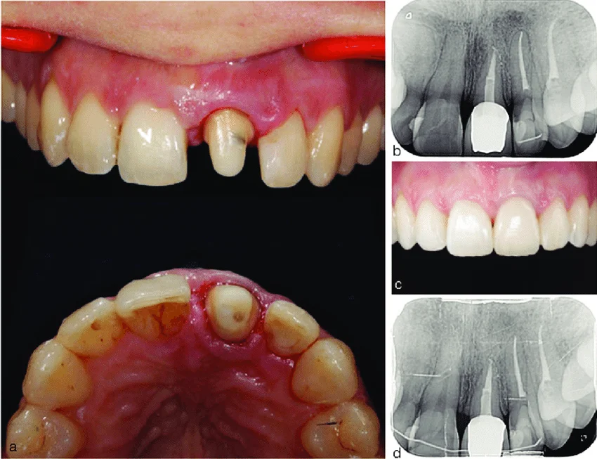 Dentist preparing tooth structure before crown and bridge placement in Patna