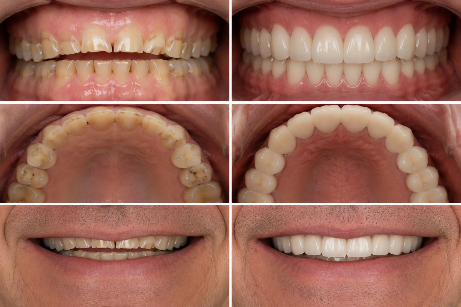 Tooth wear and occlusal rehabilitation before and after.