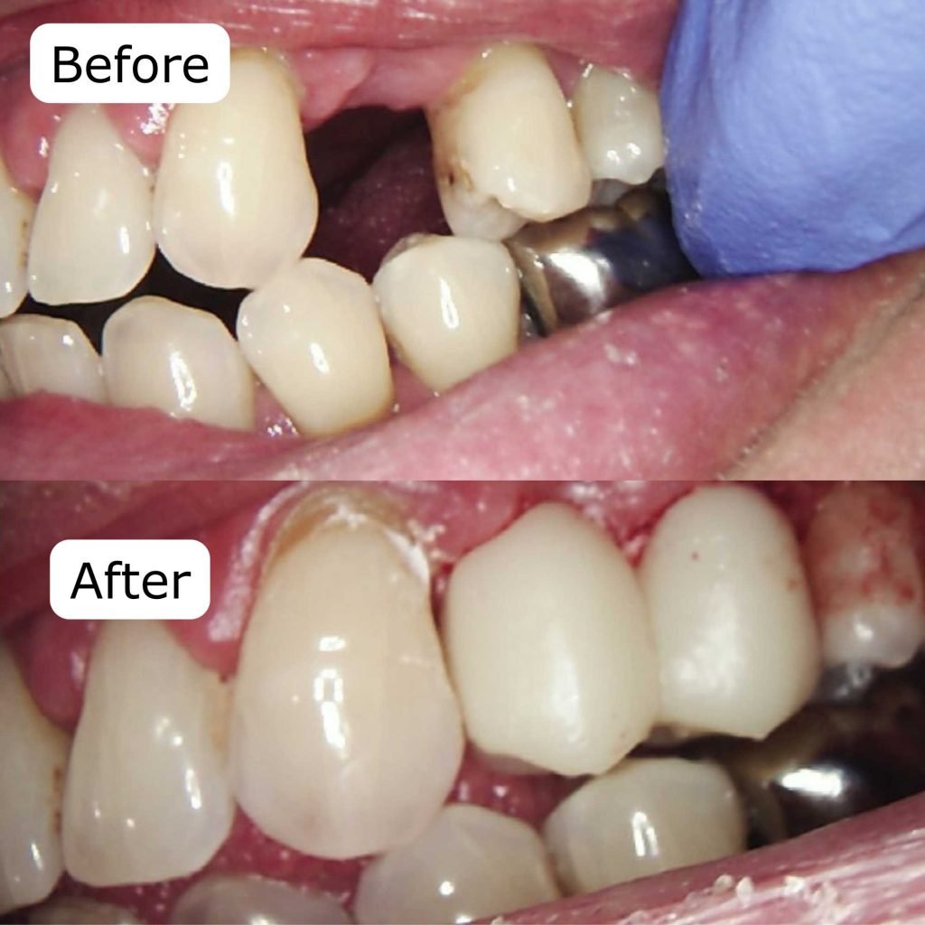 Traditional dental bridge supported by adjacent natural teeth to replace missing tooth