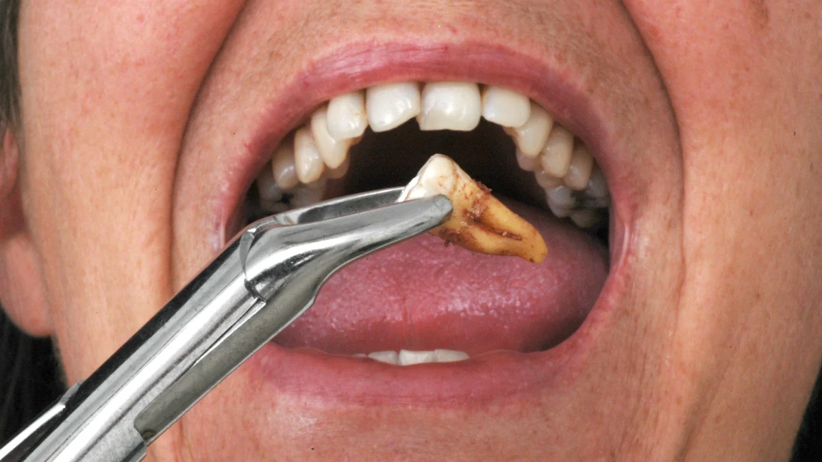 Wisdom tooth extraction in Patna