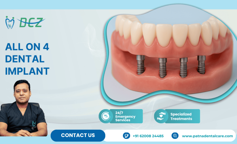 All on 4 dental implant