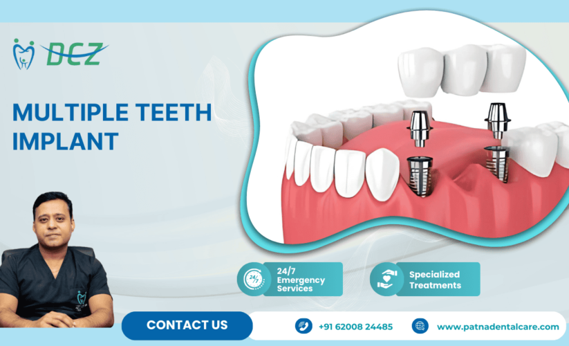 Multiple Teeth Implant