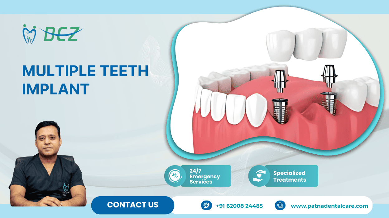Multiple Teeth Implant
