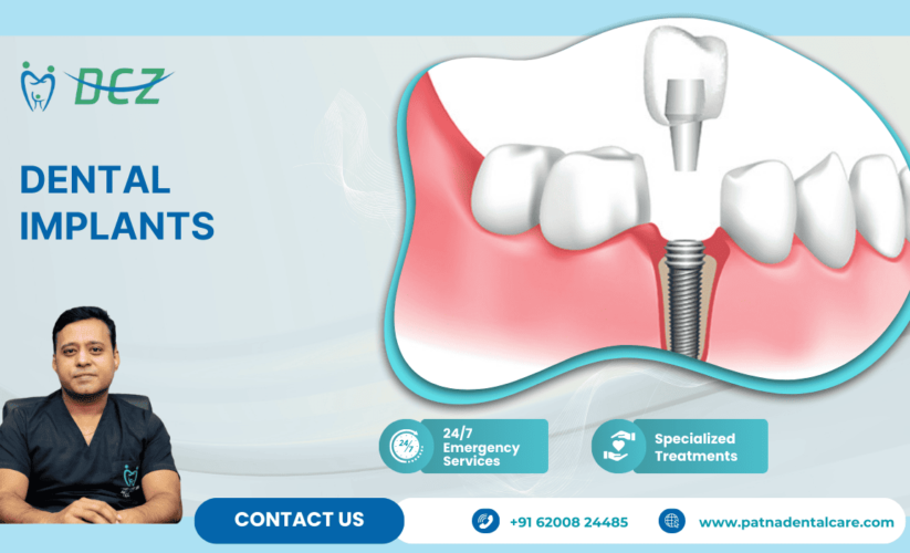 Dental Implants