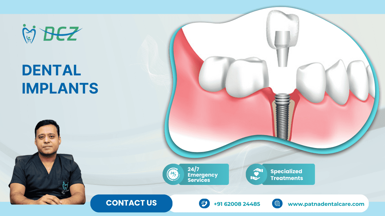 Dental Implants