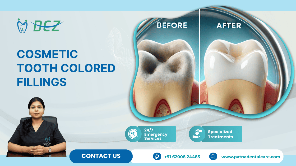 Cosmetic Tooth Colored Fillings