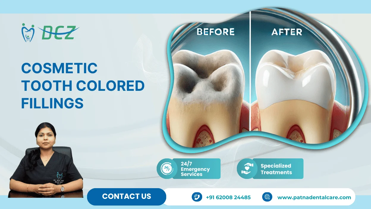 Cosmetic Tooth Colored Fillings in Patna