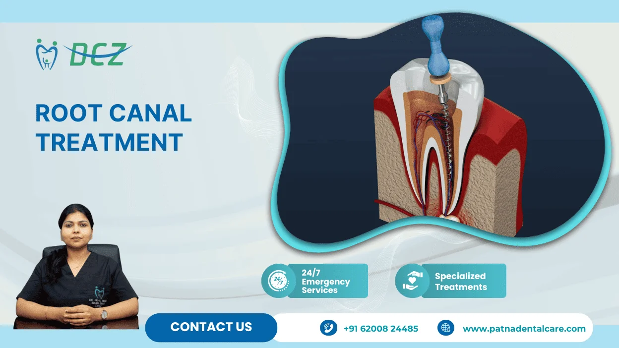 Root Canal Treatment in Patna