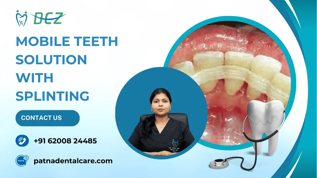 Mobile Teeth Solution with Splinting in Patna