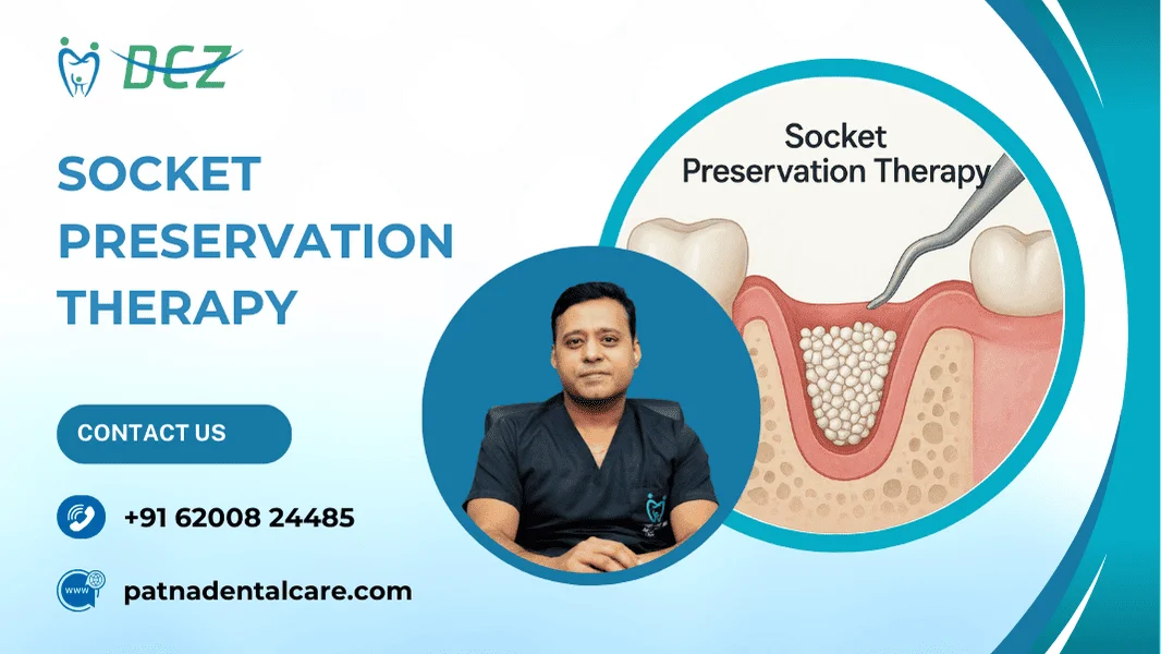 Socket Preservation Therapy in Patna