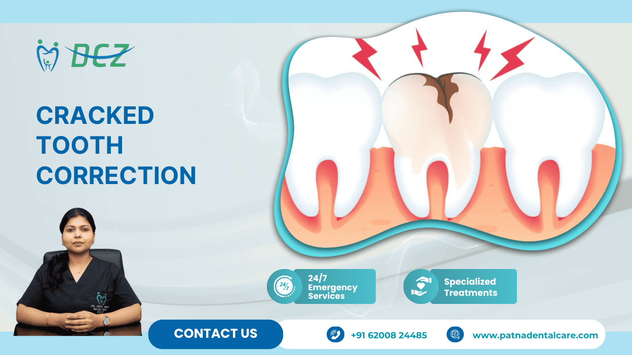 Cracked Tooth Correction in Patna