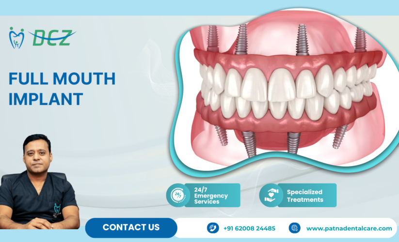 Full Mouth Implant