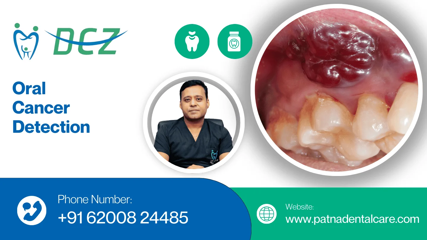 Oral Cancer Detection in Patna