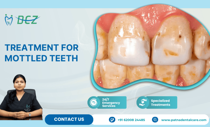 Treatment for Mottled Teeth