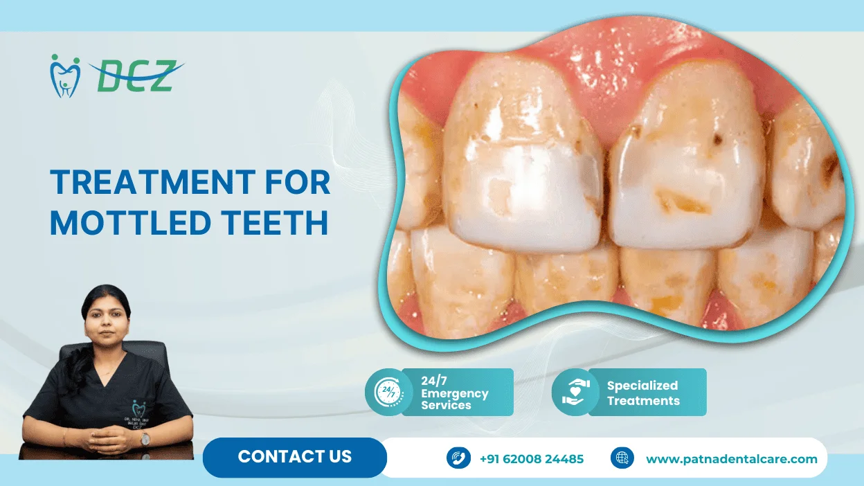 Treatment for Mottled Teeth in Patna