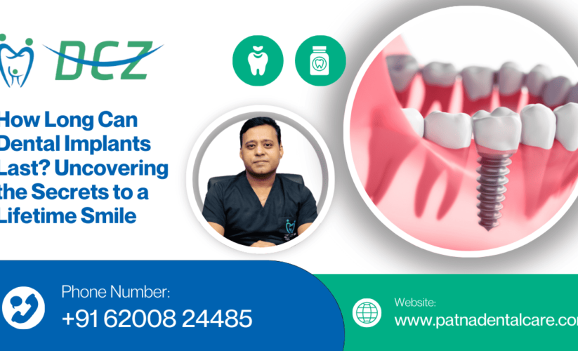 How Long Can Dental Implants Last? Uncovering the Secrets to a Lifetime Smile