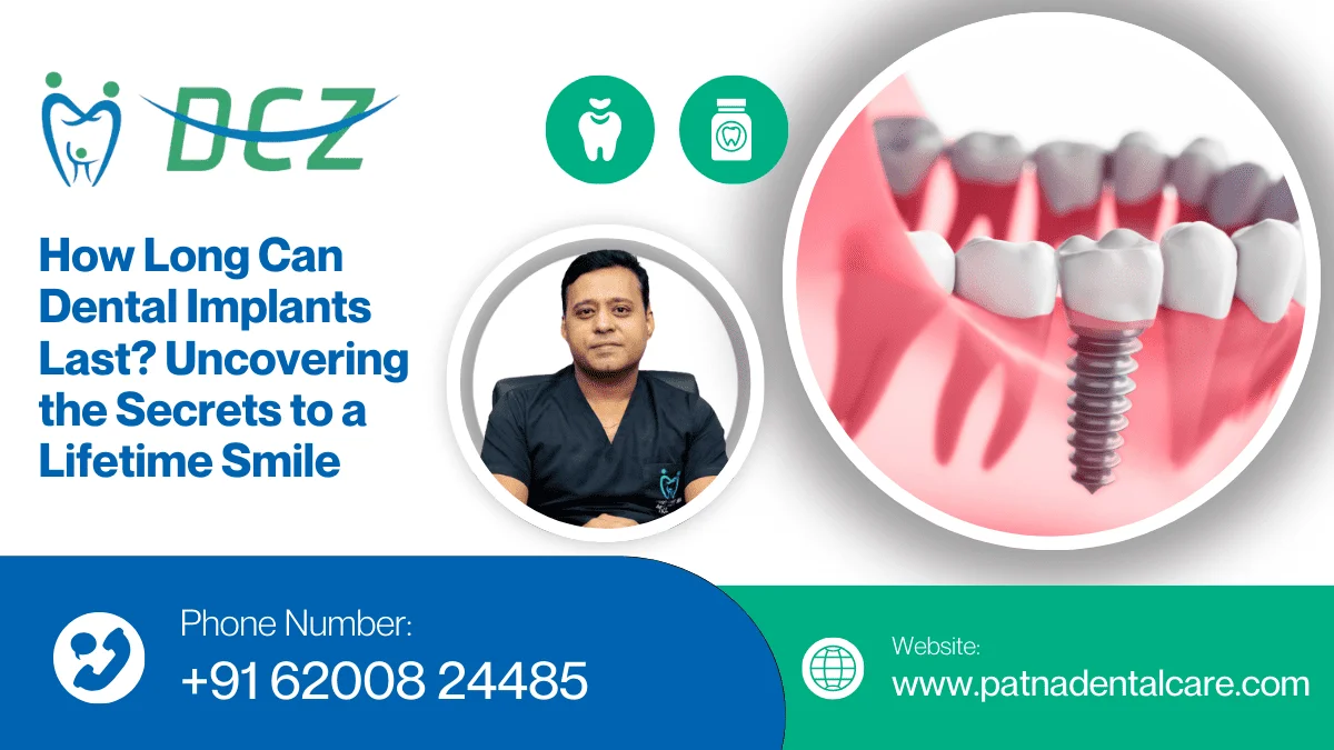 Dental Implant in Patna