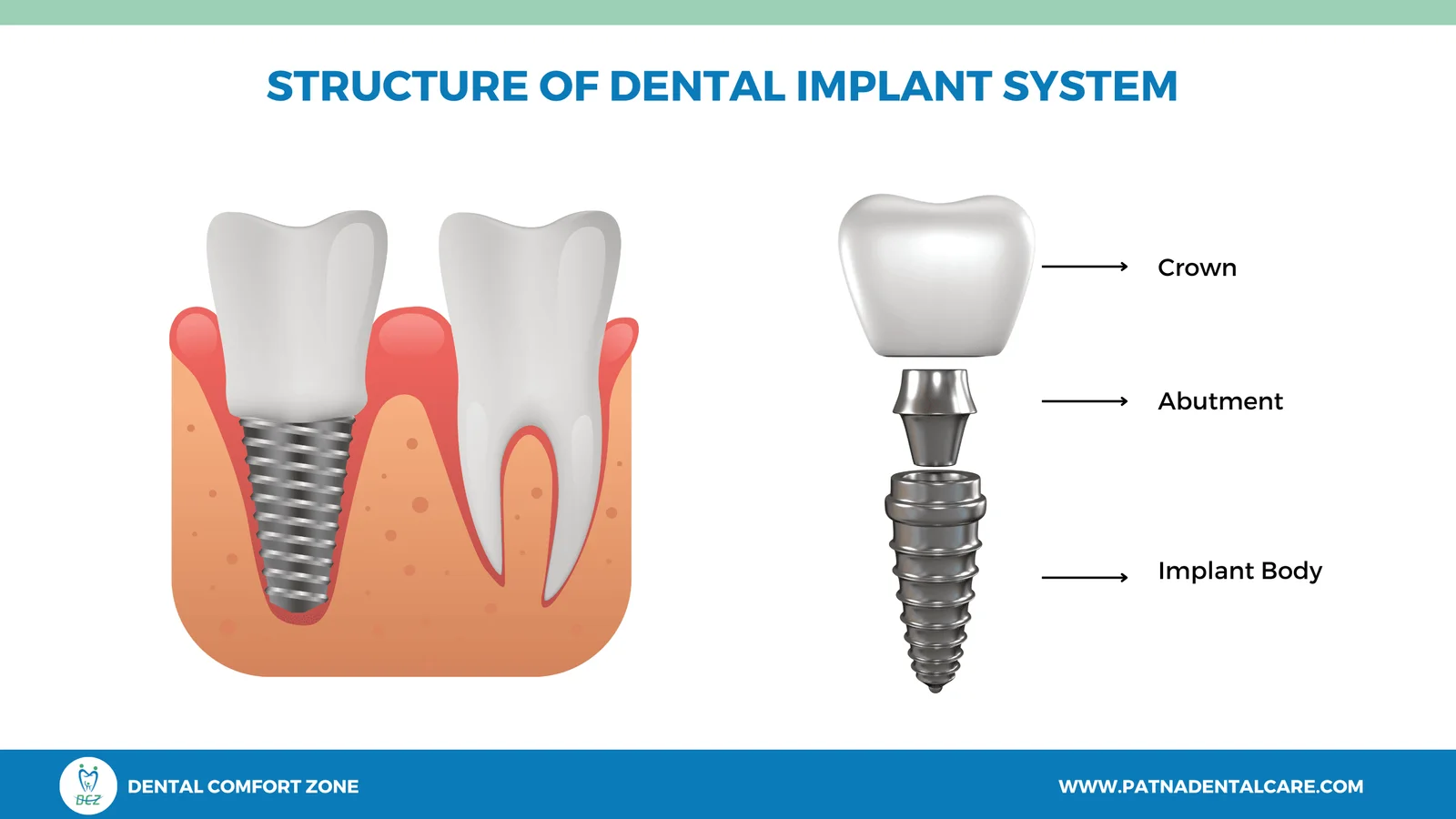 Structure of Dental Implants
