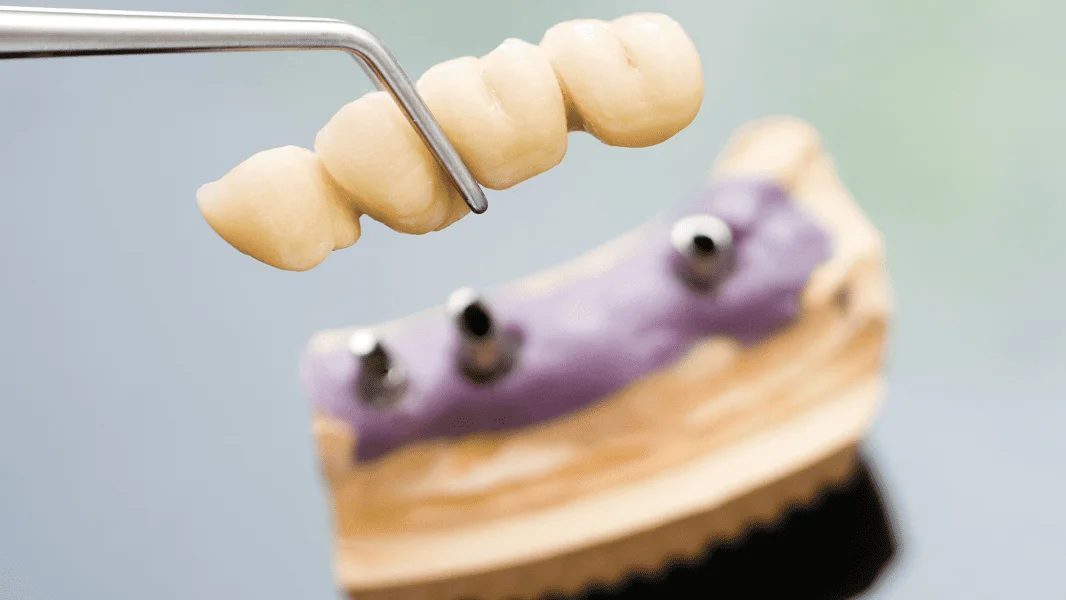 Dental Implants Patna